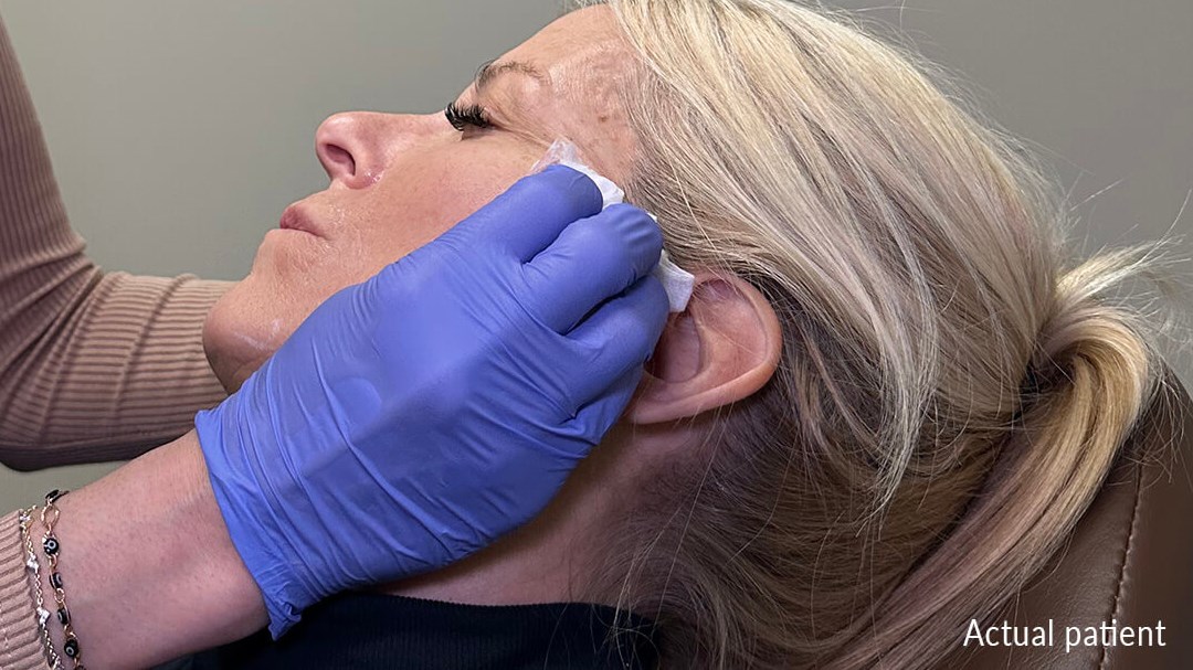 Facelift: Skincare Prep Before Your Procedure and Afterwards