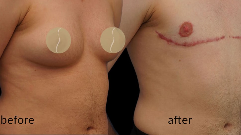 Gender Affirming - Before and 